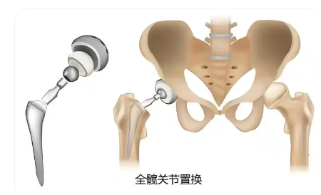 髖關節置換手術導航定位系統ropaplasty-01代理